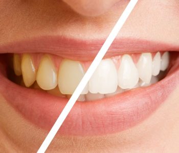 clareamento-dental