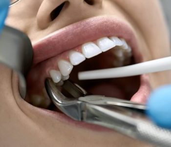 quando-se-deve-extrair-o-dente